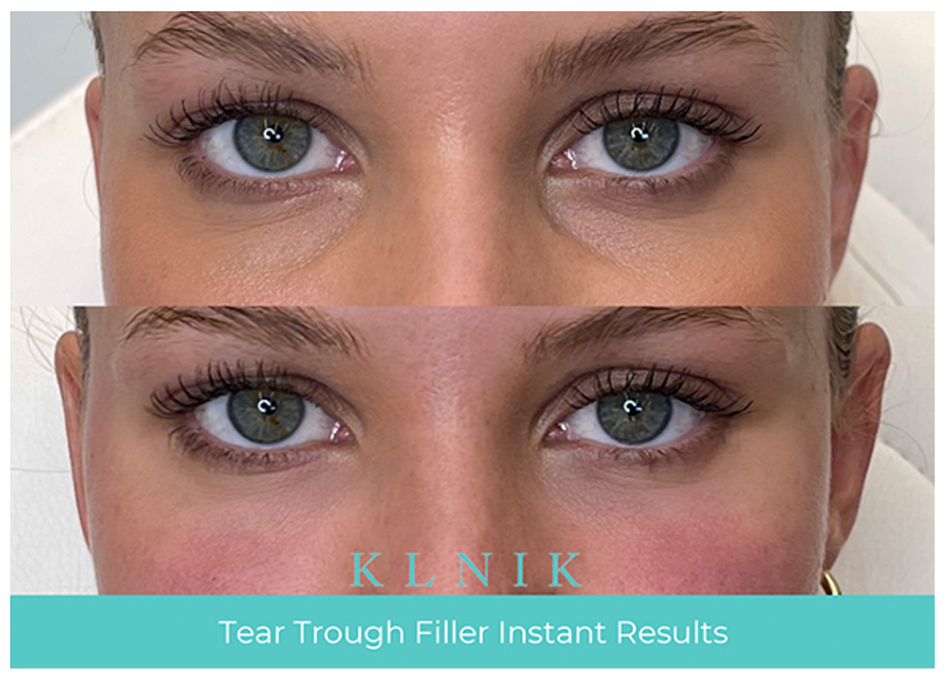 KLNIK Tear Trough Before & After